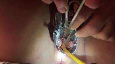 Tenaculum Grasping Cervix For Catheter 7 Min - hclips